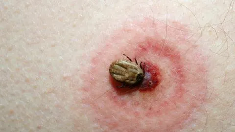 Veste extraodinară! S-a descoperit un leac extrem de eficient în tratarea maladiei Lyme