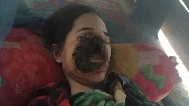 Tânără mutilată pe viaţă după o consultaţie la dentist! O bacterie a început să-i distrugă faţa