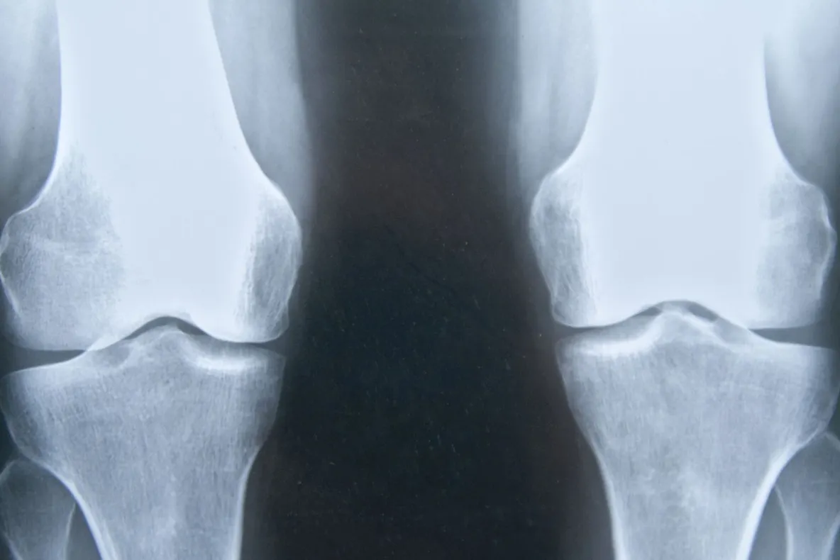 Ai probleme cu articulațiile? Verifică sistemul endocrin!