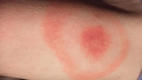 Primele semne că ai fost mușcat de căpușă! Mergi de urgenţă la medic dacă îţi apare asta pe piele