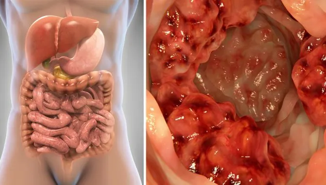 Ai aceste simptome? Mergi de URGENŢĂ la medic! E cancer de colon