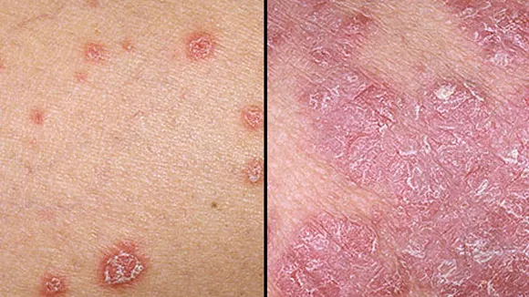 Planta miraculoasă care tratează psoriazisul, eczemele, dermatita şi alergiile pielii