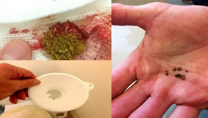 A încercat acest remediu pentru a-şi curăţa rinichii de toxine. Iată ce a păţit după 4 zile!