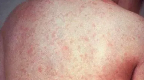 Tot ce trebuie să ştii despre VACCINUL ROR, împotriva rujeolei - oreionului - rubeolei