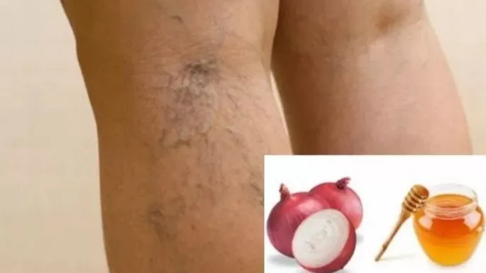 Remediul din două ingrediente care te ajută să scapi de varice DEFINITIV