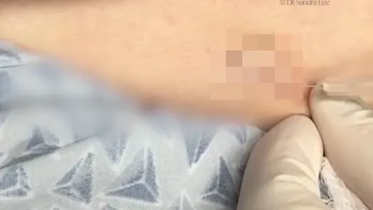 S-a dus la medic cu o umflătură lângă buric. Medicul a înţepat-o cu un ac până a pocnit! ORIBIL