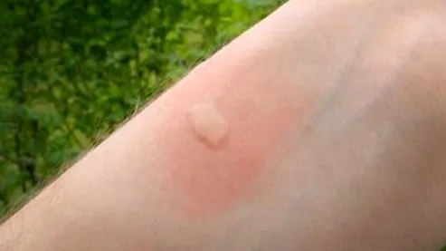 Persoanele care mănâncă asta nu sunt înțepate de țânțari