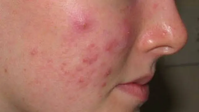 Cum îţi dai seama că ai acnee hormonală