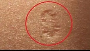 Toată lumea are această cicatrice ciudată, dar puțin știu despre ce e vorba cu adevărat