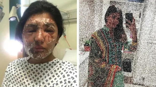 I-a distrus fața cu acid la doar 21 de ani. Azi și-a arătat iarăși chipul. Recuperarea e miraculoasă