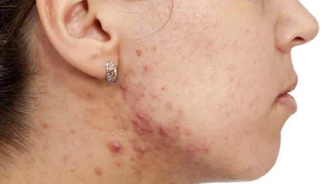 O substanță cancerigenă, descoperită în unele produsele împotriva acneei ale unor firme de cosmetice de top. Cine a dat alarma