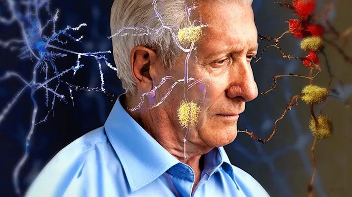 Persoanele cu această grupă de sânge sunt ferite de Alzheimer