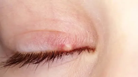 Ai o mică umflătură la ochi? Mergi de urgenţă la medic! Uite ce ascunde aceasta