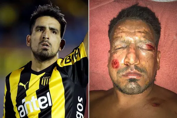 Un fotbalist de top a suferit arsuri grave la faţă de la artificii