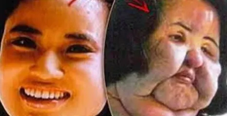 Timp de 20 de ani, şi-a injectat ulei pentru gătit în faţă. De ce căuta femeia frumuseţea eternă