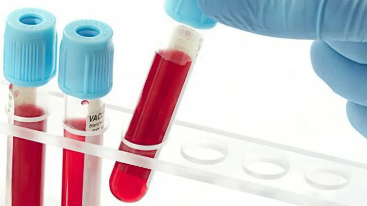 Analiza de sânge care depistează cancerul. Rezultatele sunt uimitoare