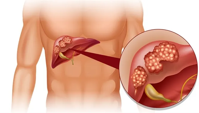 Primele simptome ale cancerului de ficat pe care mulţi le ignoră