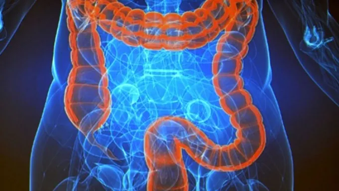 Medicii au descoperit o posibilă cauză a creșterii cazurilor misterioase de cancer de colon la persoanele sub 50 de ani
