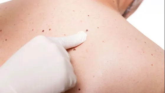 Cancerul de piele: melanomul, bazaliomul si spinaliomul