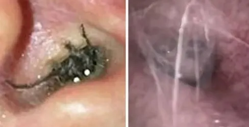 Auzea întruna un ţiuit în ureche. A mers la ORL-ist, iar ce a scos de acolo este şocant!