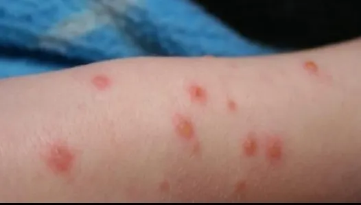 RUJEOLA, amenințare iminentă, urmează 12-24 de luni foarte dificile. Alertă sanitară globală