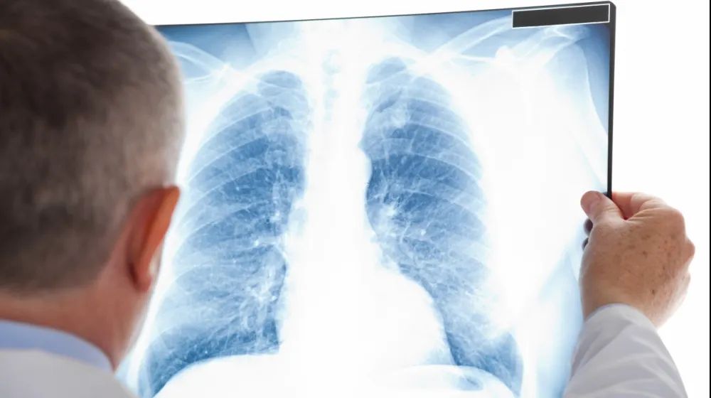 Crește alarmantă a numărul cazurilor de TUBERCULOZĂ la copii! Semnal de alarmă al medicilor: SIMPTOMELE care ar trebui să ne dea de gândit