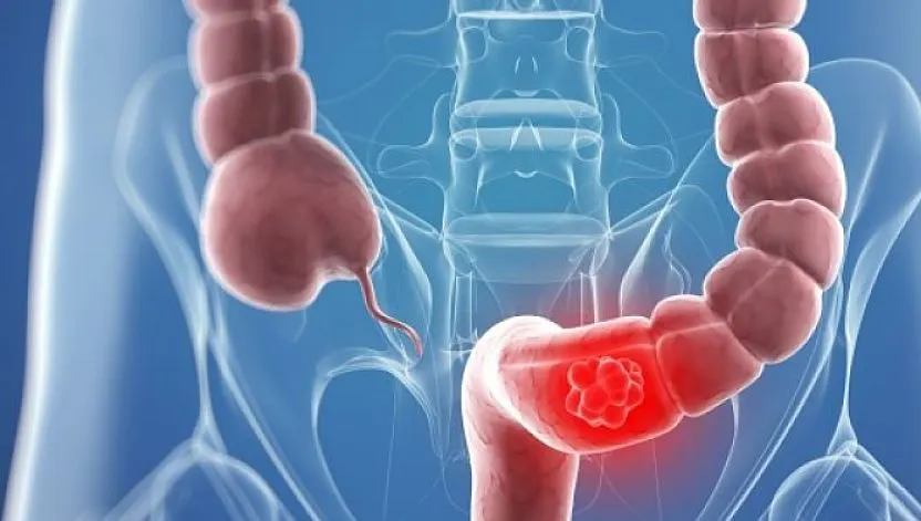 Cancerul de colon: Cauze și simptome