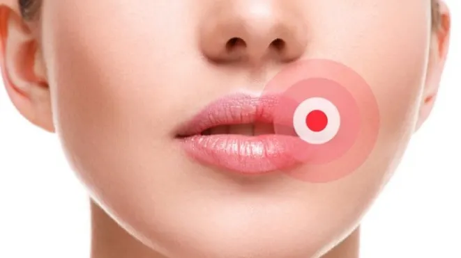 Cum să scapi de herpes simplu şi rapid. Acesta este cel mai eficient tratament