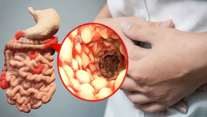 Boala Crohn. Principalele simptome