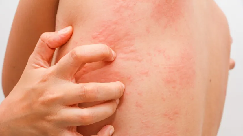 Urticaria acuta. Principalele semne
