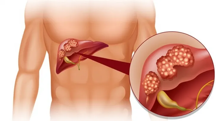 Primele simptome ale cancerului de ficat pe care mulţi le ignoră