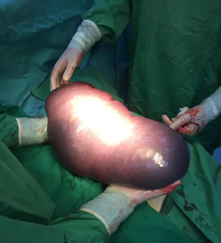 Medicii au decis să îi scoată splina. În timpul operației au avut un ȘOC. Are peste 6 kg!