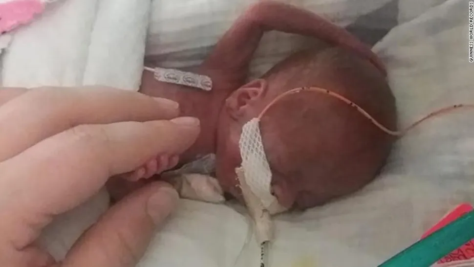 Cel mai mic bebeluș din lume a fost născut în SUA. Micuțul a intrat în Cartea Recordurilor