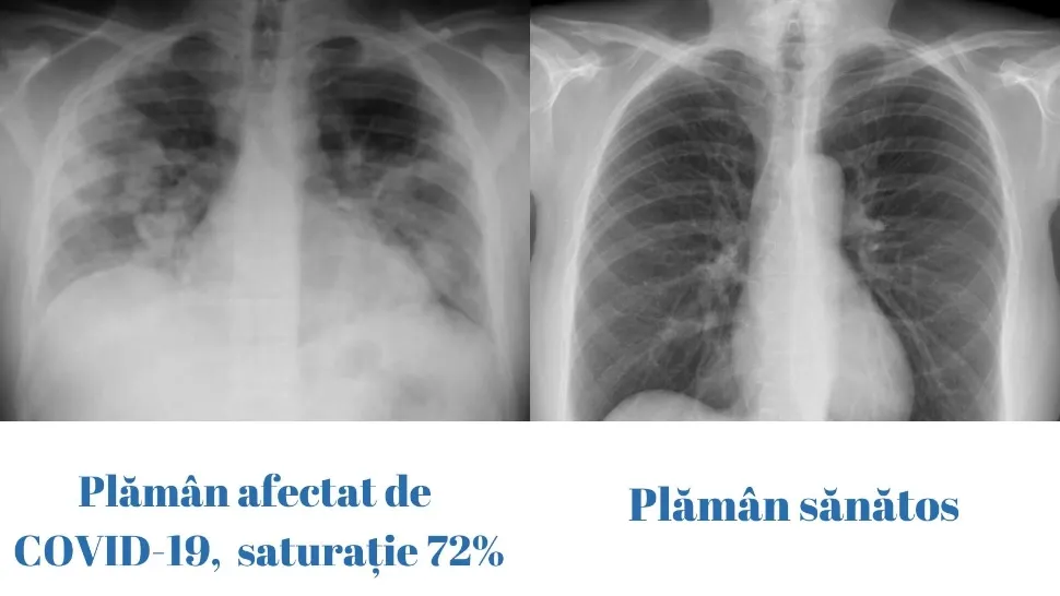 Cum arată plămânii unui tânăr de 23 de ani grav afectat de Covid-19. Avertizările specialiștilor