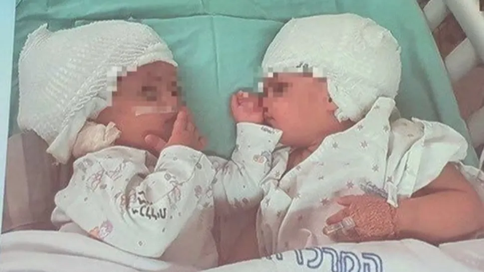 FOTO | Siameze unite în dreptul cefei, separate după o intervenţie chirurgicală extrem de rară, în Israel