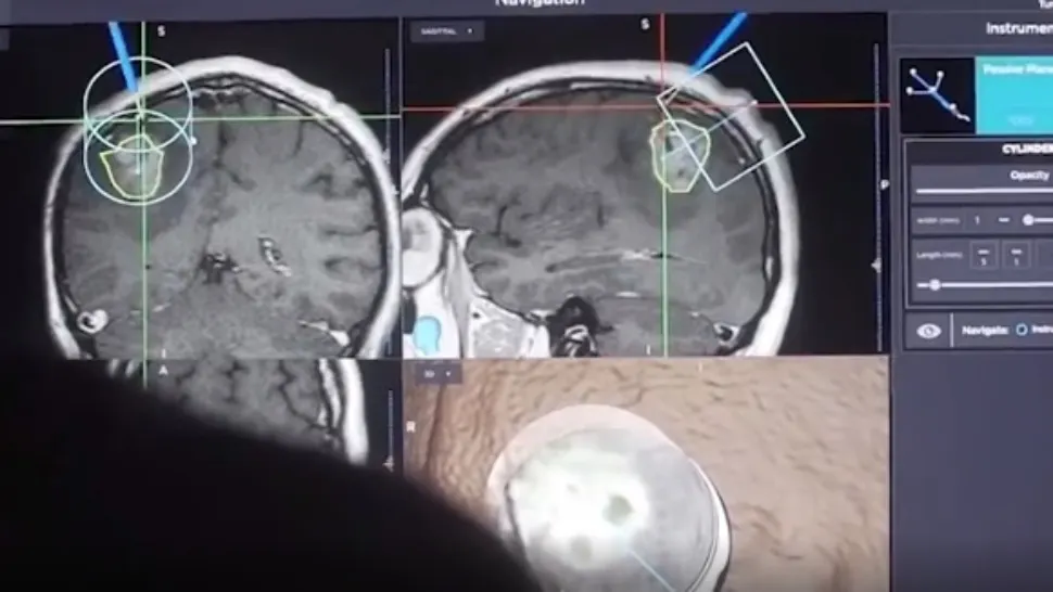 VIDEO | Femeie cu tumoră cerebrală de 5 centimetri, operată cu succes în Iași. Declarațiile emoționante ale pacientei