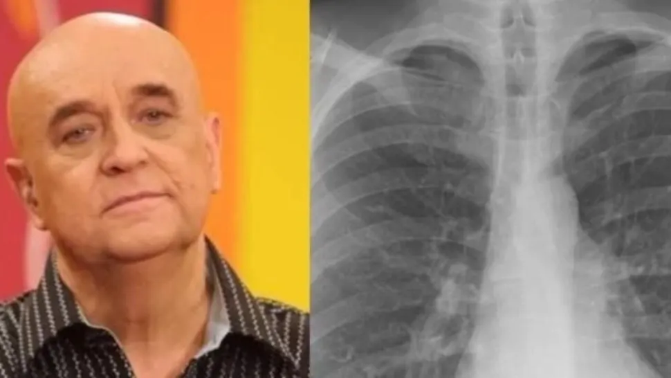Ce este pneumonia de aspirație, boala care l-a ucis pe Benone Sinulescu. Cu toții facem greșeala asta ZILNIC!