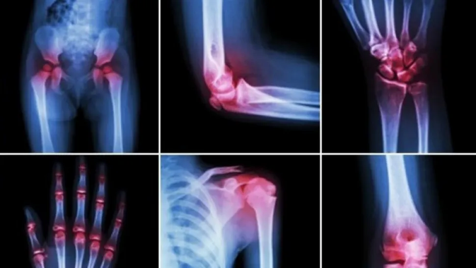 Amestecul care face minuni în artroză, artrită şi coxartroză - medicii, uimiți de efect