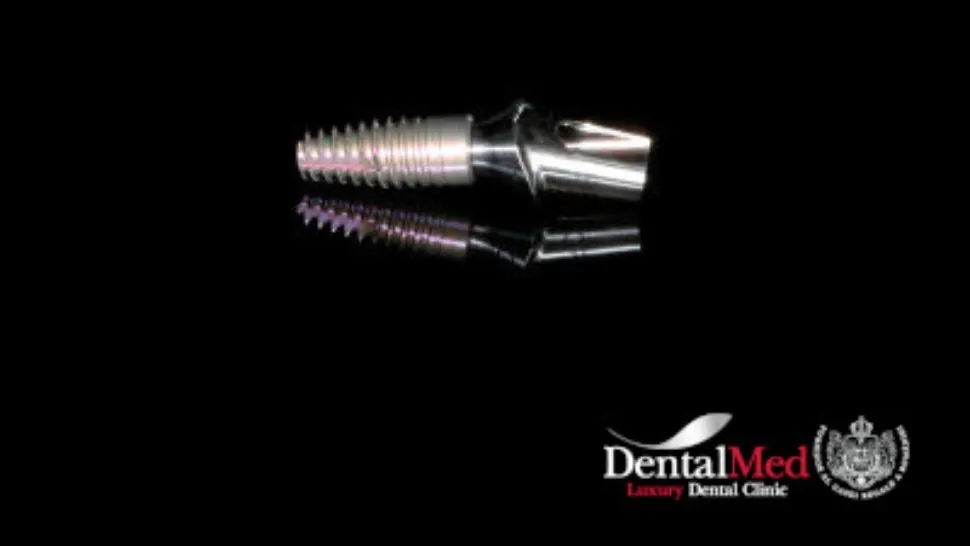 Implantul dentar doare? Cât durează recuperarea post-operatorie? (P)
