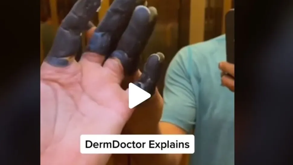 VIDEO – I s-au înnegrit degetele brusc – A mers de urgență la spital și medicii i-au dat verdictul crunt: amputate pe loc