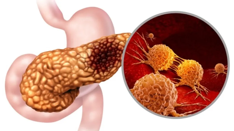 Testul de respirație care ar putea depista cancerul pancreatic