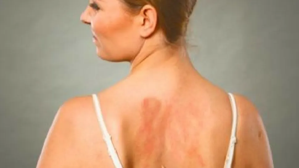 Alergia la soare este mai periculoasă decât se crede. Cum să o recunoști și cum să o ții sub control 