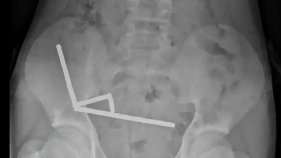 Caz șocant: un băiat de 13 ani, operat de urgență după ce a înghițit aproape 200 de magneți
