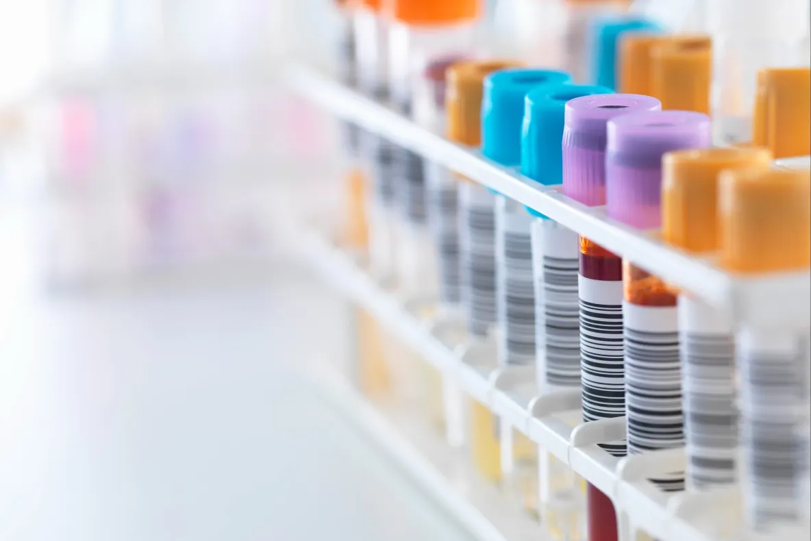 România, în topul UE la diagnostice HIV tardive. Peste 60% dintre cazuri sunt depistate în stadii avansate
