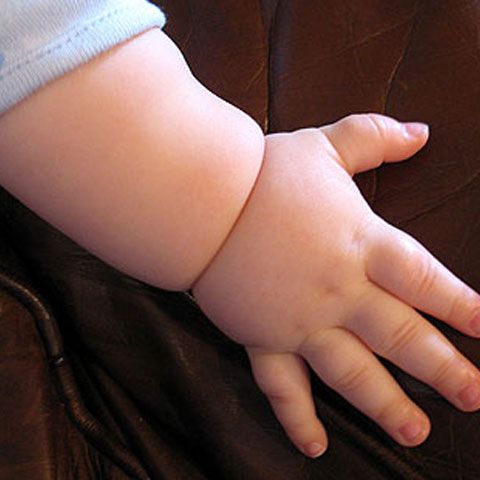 O fetiţă s-a născut fără o mână după ce medicii au dat asigurări că nu sunt probleme