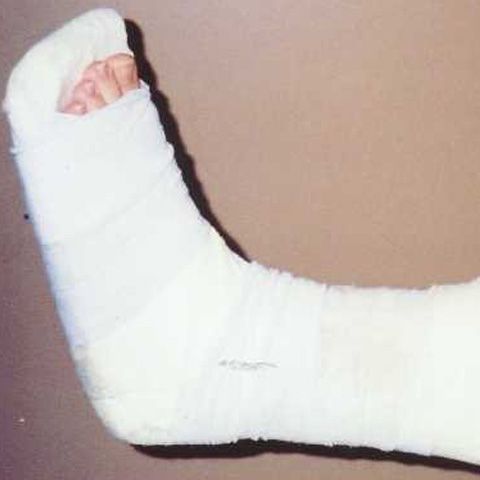 Medicii englezi au inventat "osul injectabil"