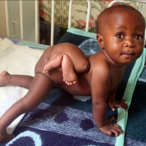 O fetiţă de opt luni din Zambia va fi supusă unei operaţii pentru îndepărtarea geamănului parazit