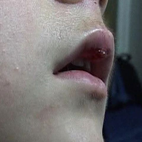 Un elev de 12 ani a fost muşcat de buză, de tatăl colegului său, în faţa şcolii