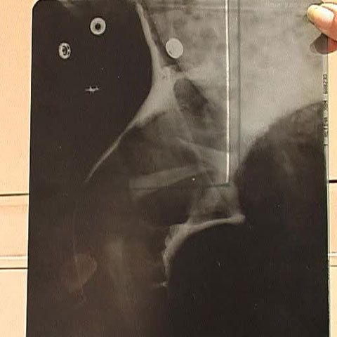 Un bebeluş născut la Spitalul Judeţean din Galaţi şi-a rupt piciorul în spital