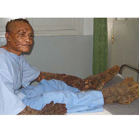 Omul-arbore, operat a noua oară pentru extirparea negilor care îi acoperă corpul - GALERIE FOTO